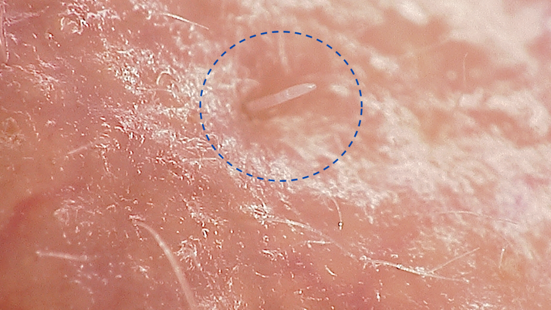 Microscope image of a Demodex folliculorum mite on the skin