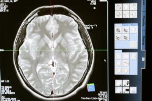 a x-ray of the brain