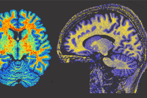 Image of brain scan