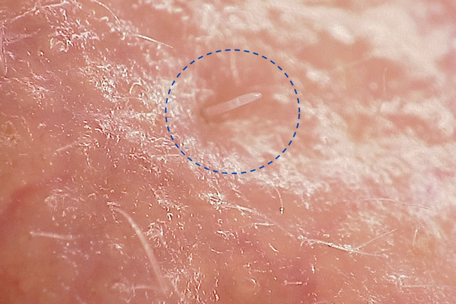 Microscope image of a Demodex folliculorum mite on the skin