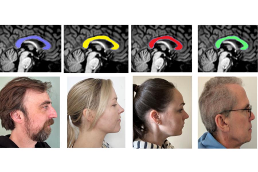 Top row. The corpus callosum shown in false colours. Bottom row: Rene Westerhausen, Emma Karlsson, Leah Johnstone and David Carey